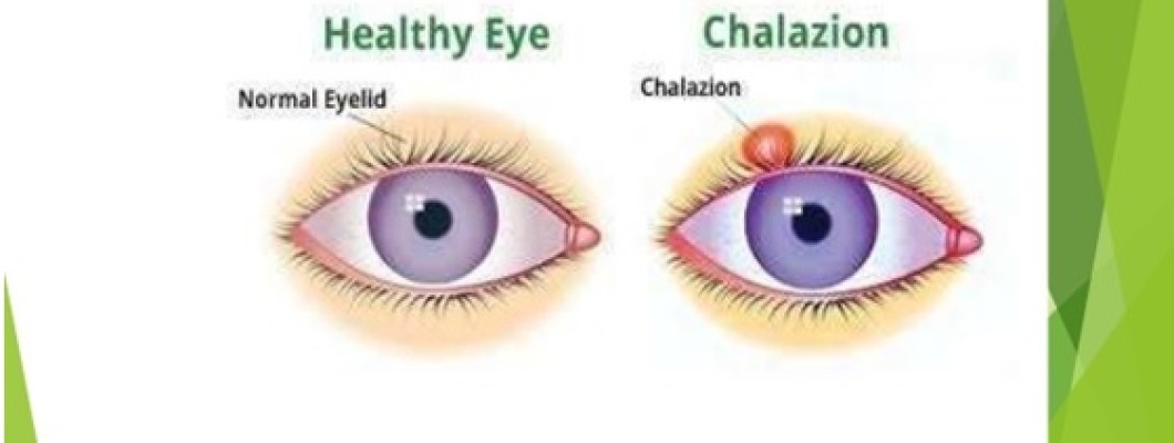 Chalazion