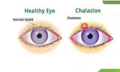 Chalazion